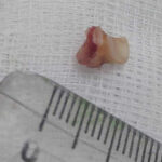 В Новосибирске врачи помогли мальчику, который случайно вдохнул выпавший молочный зуб