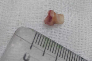 В Новосибирске врачи помогли мальчику, который случайно вдохнул выпавший молочный зуб